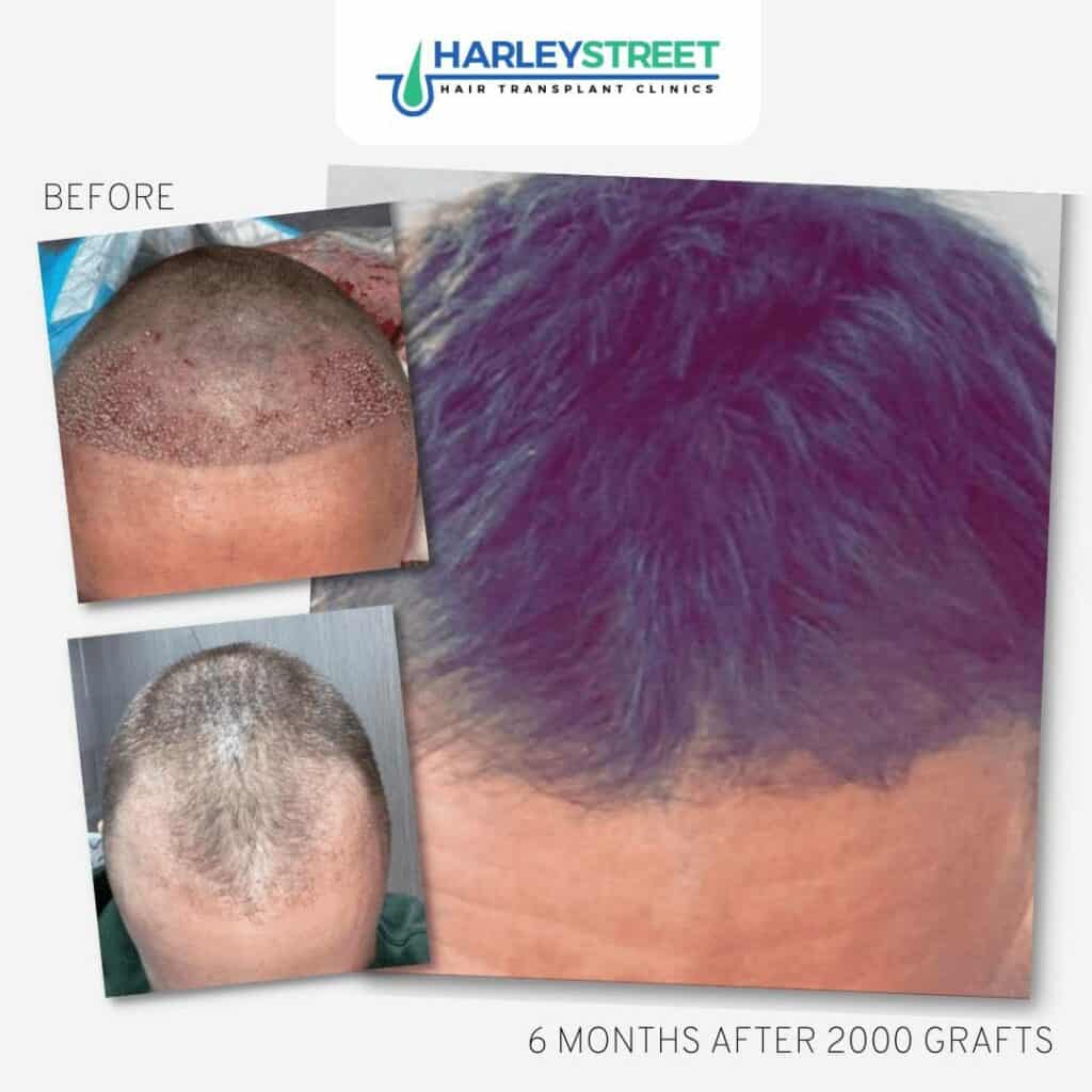 Hair Transplant Before & After Results 10 FUE-Before-and-After-9