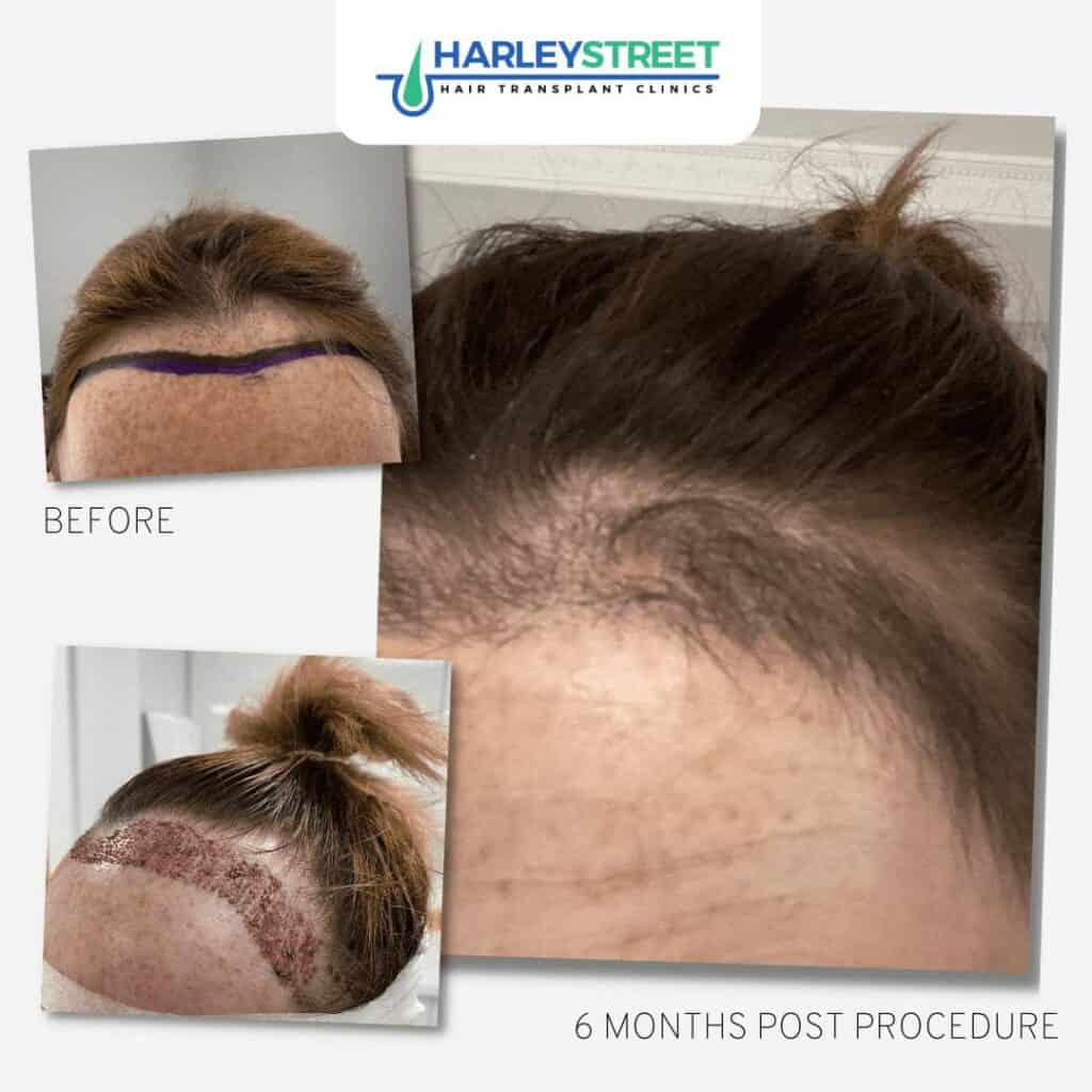 Hair Transplant Before & After Results 15 FUE-Female-Hair-Transplant-Before-and-After