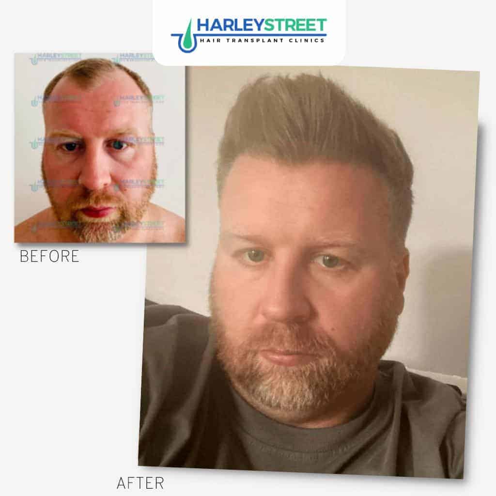 Hair Transplant Before & After Results 16 Harley-Street-Hair-Transplant-Clinics-patient-Aaron-before-and-after-1