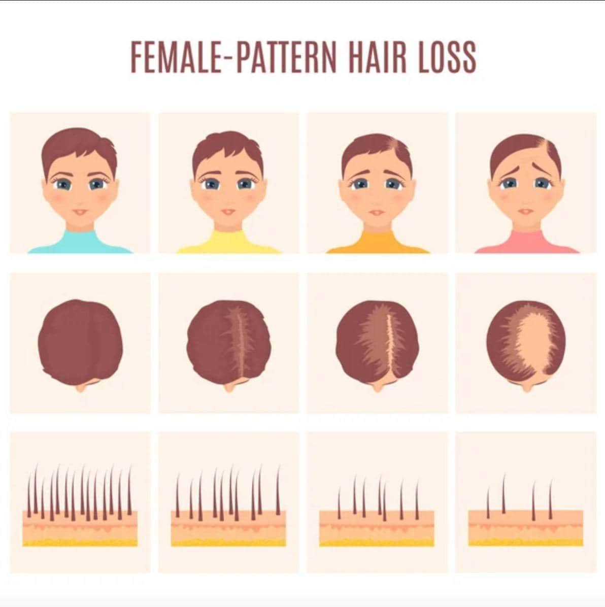 Sudden hair loss in women discount