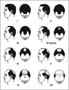 male-pattern-baldness-or-androgenetic-alopecia-230x300-1